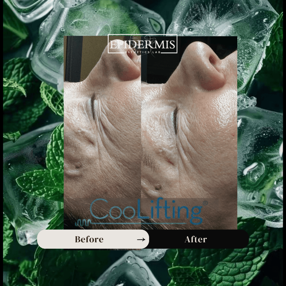 Comparison of a person's face showing reduced wrinkles after treatment, labeled 'Before' and 'After'.