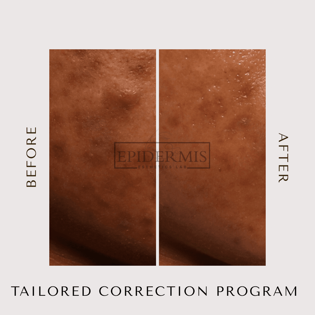 Close-up of skin showing before and after treatment results, with visible improvement in skin texture and appearance.