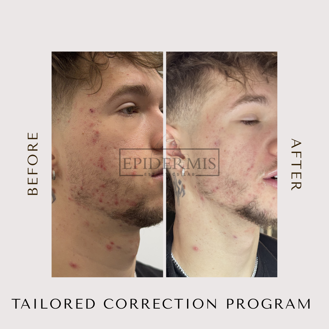 Side-by-side comparison of a man's face showing skin improvement after a correction program.
