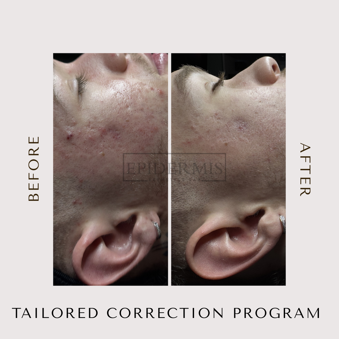 Comparison of skin before and after treatment, showing improved skin texture and clarity, with side profile views of a person's face and ear.