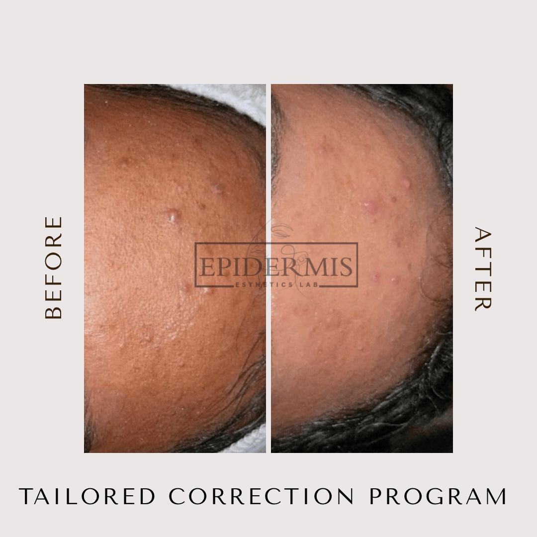 Comparison of skin before and after treatment showing improved skin texture and reduced blemishes.